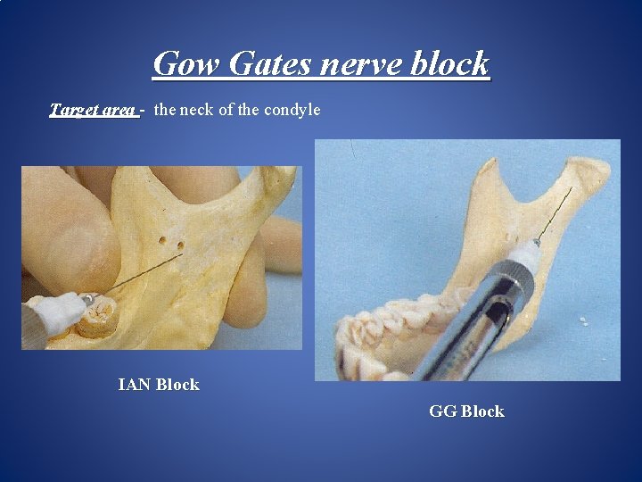 Gow Gates nerve block Target area - the neck of the condyle IAN Block
