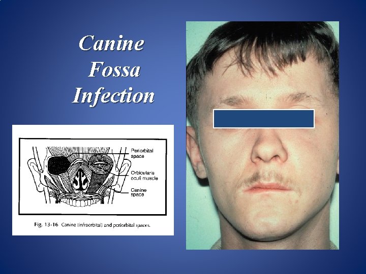 Canine Fossa Infection 