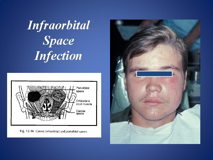Infraorbital Space Infection 