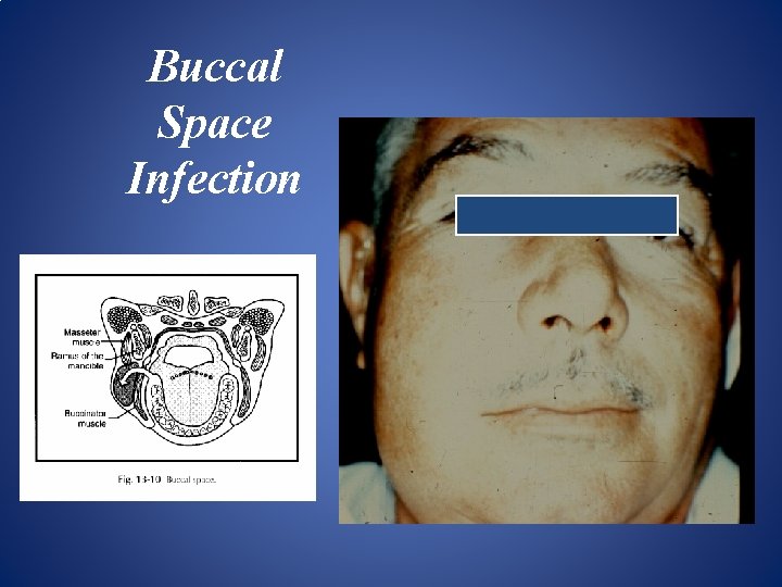 Buccal Space Infection 