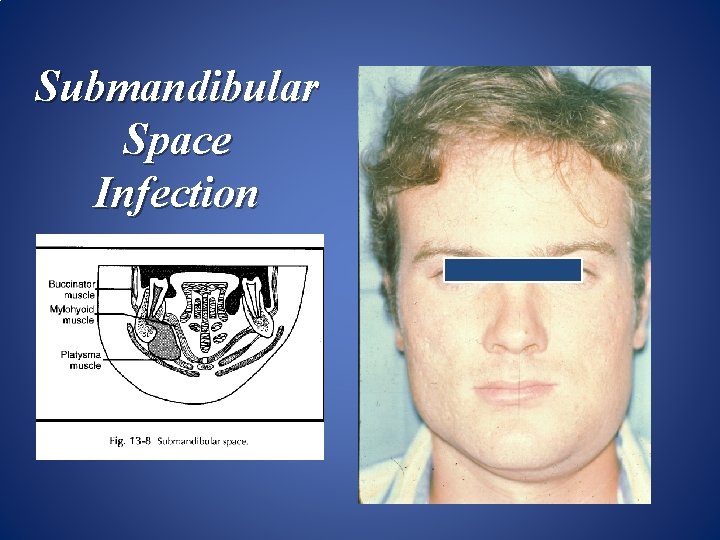 Submandibular Space Infection 