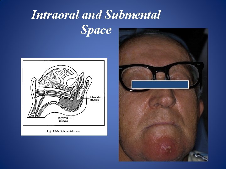 Intraoral and Submental Space 