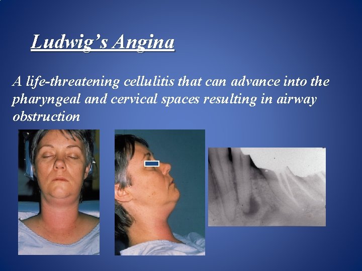 Ludwig’s Angina A life-threatening cellulitis that can advance into the pharyngeal and cervical spaces