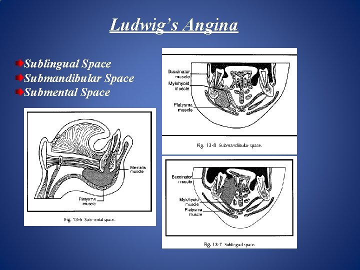 Ludwig’s Angina Sublingual Space Submandibular Space Submental Space 