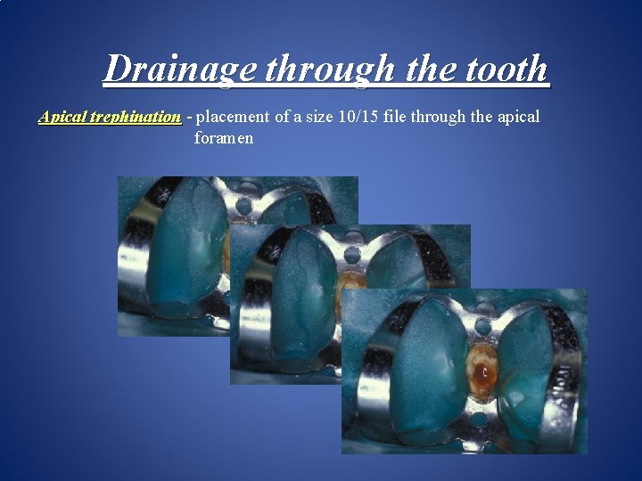 Drainage through the tooth Apical trephination - placement of a size 10/15 file through