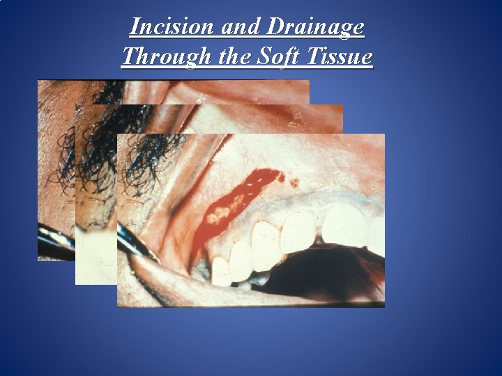 Incision and Drainage Through the Soft Tissue 