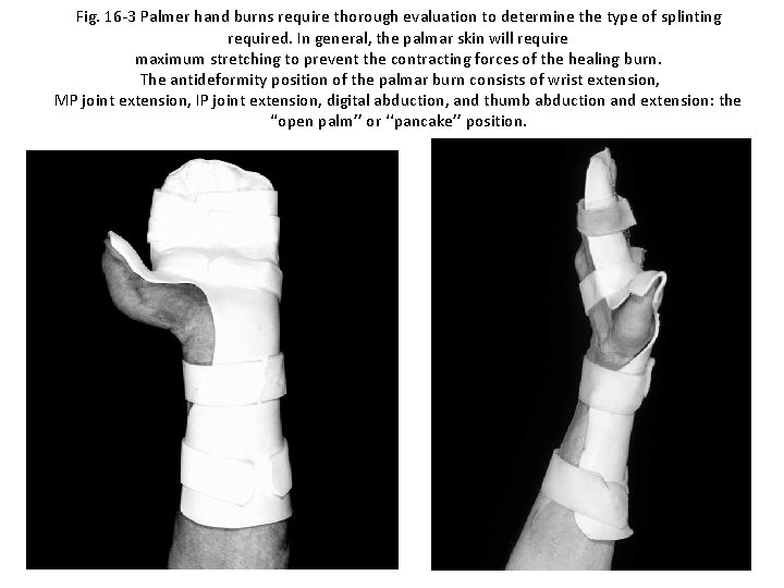 Fig. 16 -3 Palmer hand burns require thorough evaluation to determine the type of