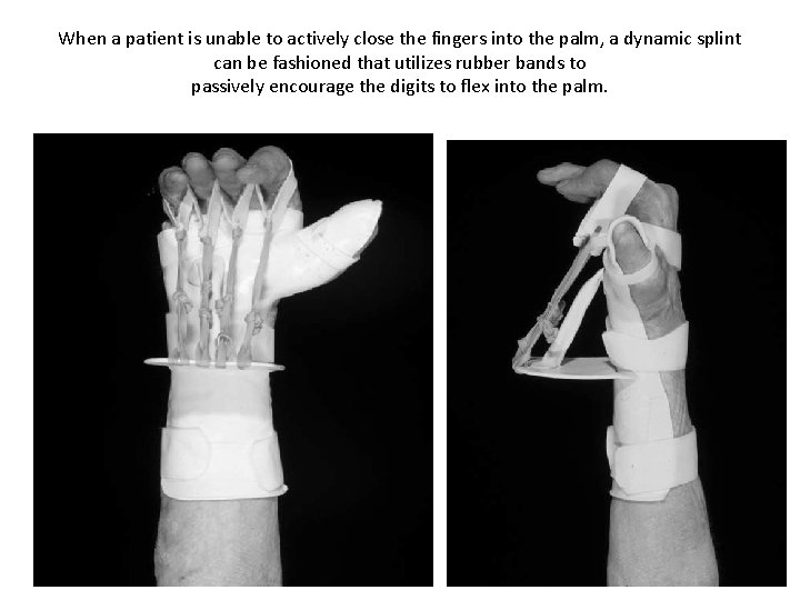 When a patient is unable to actively close the fingers into the palm, a