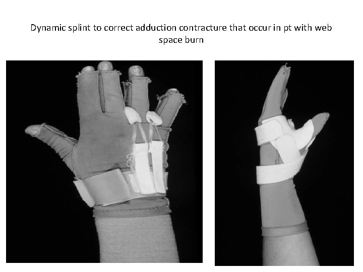 Dynamic splint to correct adduction contracture that occur in pt with web space burn