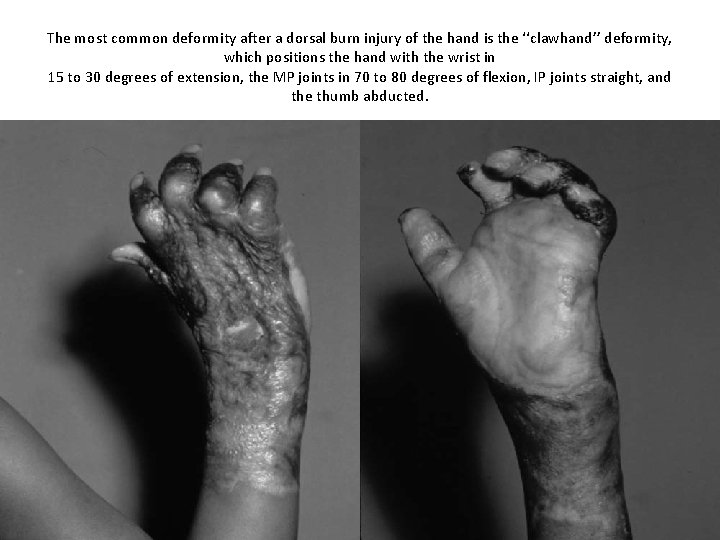 The most common deformity after a dorsal burn injury of the hand is the