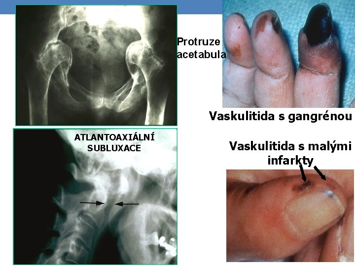 Protruze acetabula Vaskulitida s gangrénou ATLANTOAXIÁLNÍ SUBLUXACE Vaskulitida s malými infarkty 