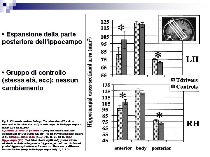  • Espansione della parte posteriore dell’ippocampo • Gruppo di controllo (stessa età, ecc):