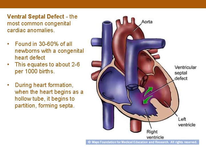 Ventral Septal Defect - the most common congenital cardiac anomalies. • Found in 30