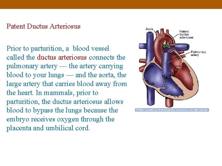 Patent Ductus Arteriosus Prior to parturition, a blood vessel called the ductus arteriosus connects
