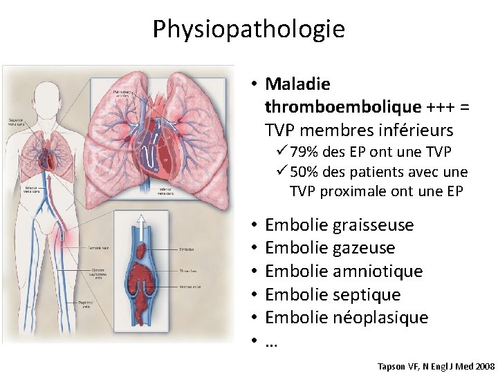 Physiopathologie • Maladie thromboembolique +++ = TVP membres inférieurs ü 79% des EP ont