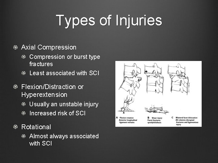 Types of Injuries Axial Compression or burst type fractures Least associated with SCI Flexion/Distraction