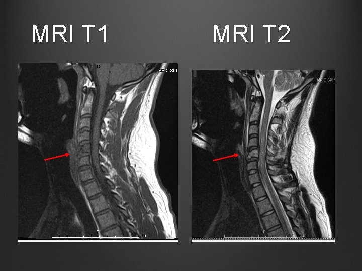 MRI T 1 MRI T 2 