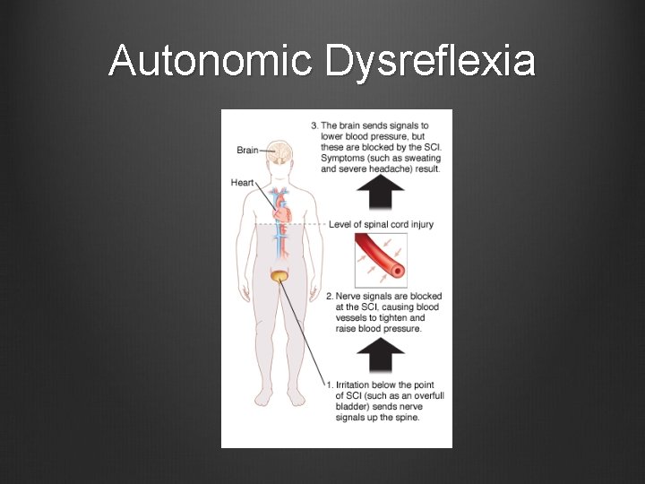 Autonomic Dysreflexia 