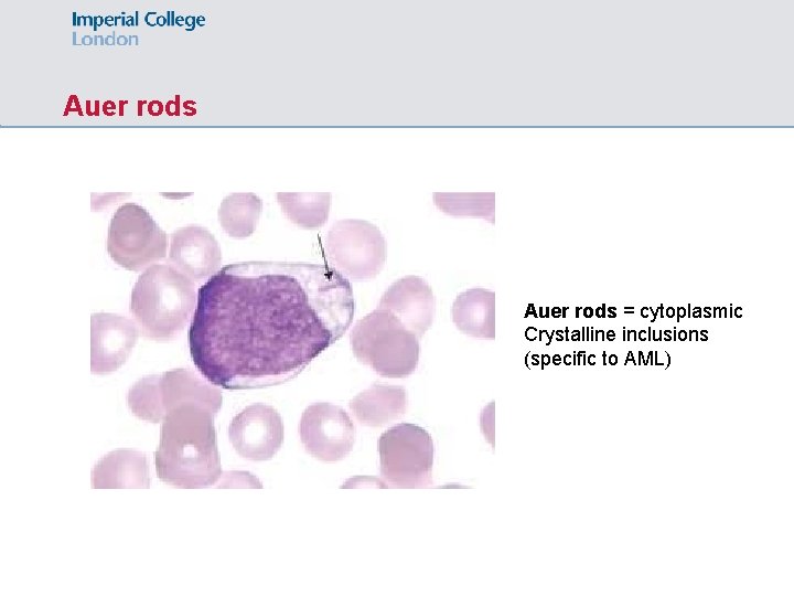 Auer rods = cytoplasmic Crystalline inclusions (specific to AML) 