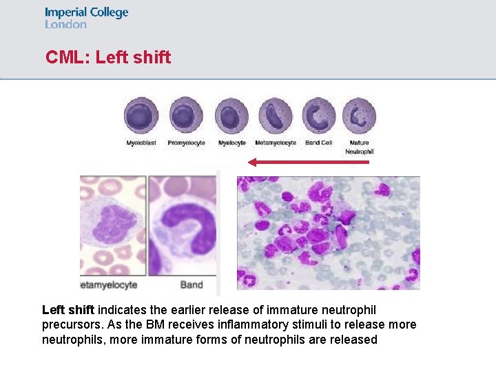 CML: Left shift indicates the earlier release of immature neutrophil precursors. As the BM