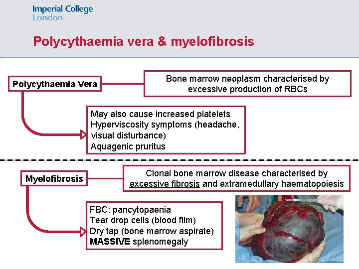 Polycythaemia vera & myelofibrosis Polycythaemia Vera Bone marrow neoplasm characterised by excessive production of