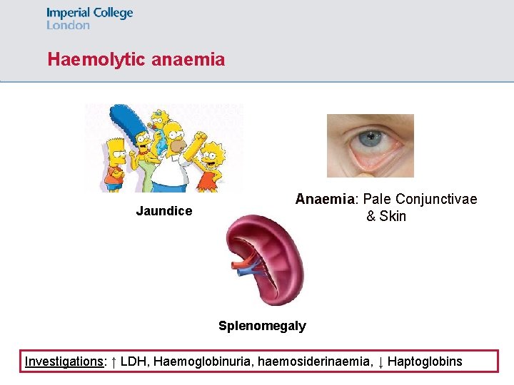 Haemolytic anaemia Jaundice Anaemia: Pale Conjunctivae & Skin Splenomegaly Investigations: ↑ LDH, Haemoglobinuria, haemosiderinaemia,