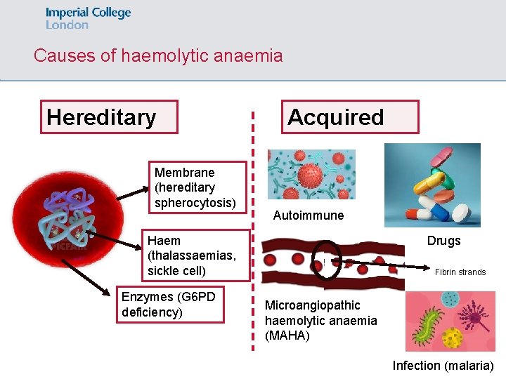 Causes of haemolytic anaemia Hereditary Membrane (hereditary spherocytosis) Acquired Autoimmune Haem (thalassaemias, sickle cell)