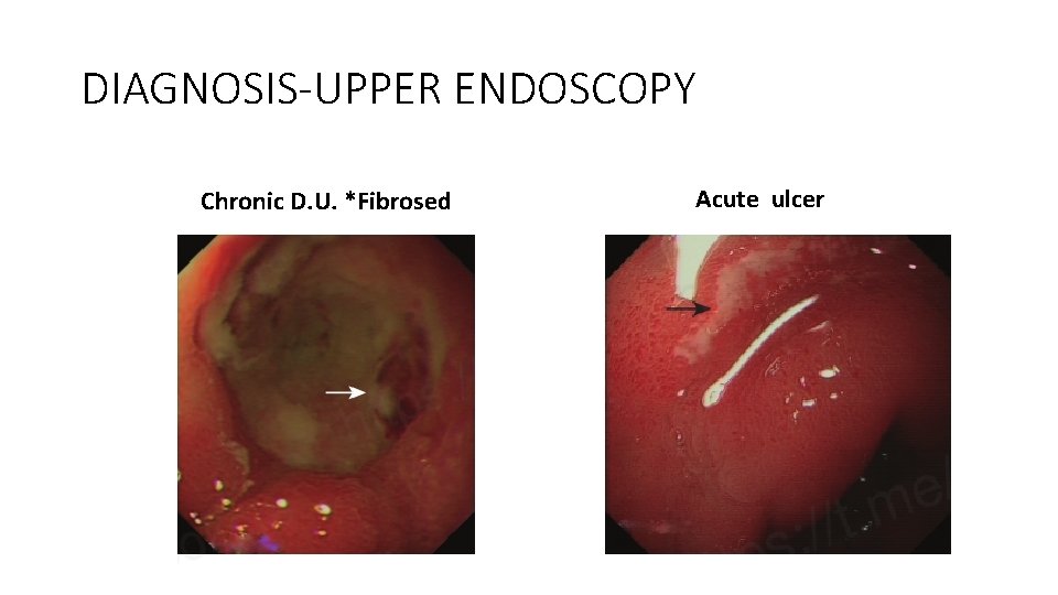 DIAGNOSIS-UPPER ENDOSCOPY Chronic D. U. *Fibrosed Acute ulcer 