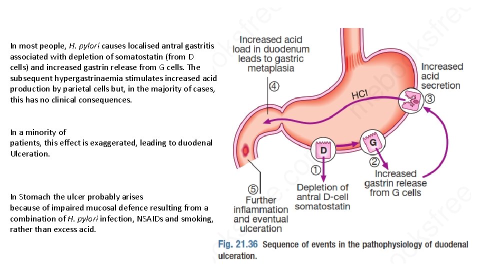 In most people, H. pylori causes localised antral gastritis associated with depletion of somatostatin