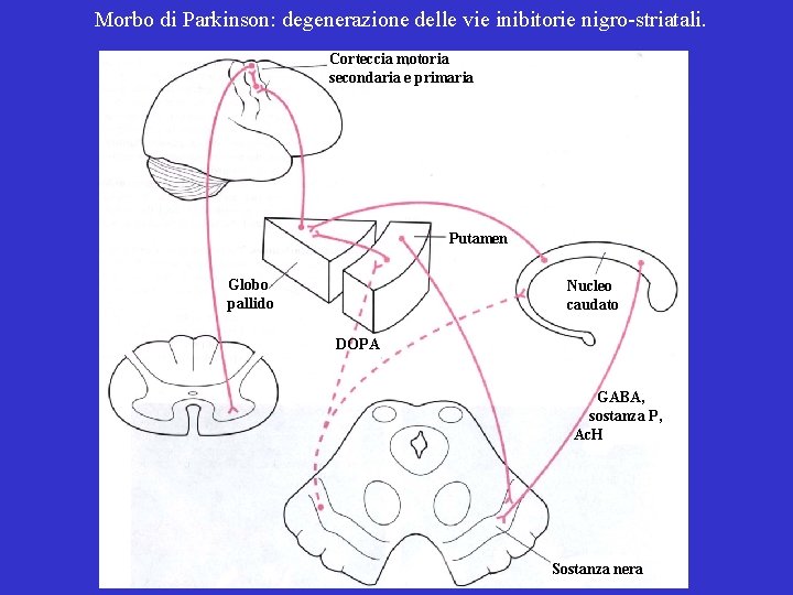 Morbo di Parkinson: degenerazione delle vie inibitorie nigro-striatali. Corteccia motoria secondaria e primaria Putamen