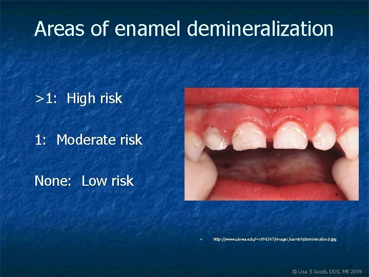 Areas of enamel demineralization >1: High risk 1: Moderate risk None: Low risk n