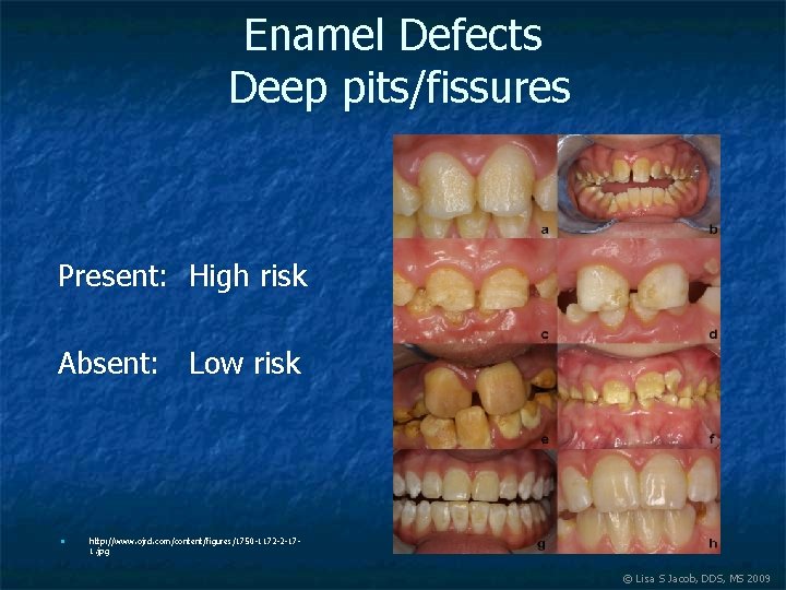 Enamel Defects Deep pits/fissures Present: High risk Absent: Low risk n http: //www. ojrd.