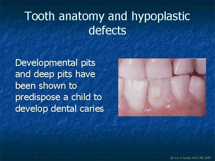 Tooth anatomy and hypoplastic defects Developmental pits and deep pits have been shown to