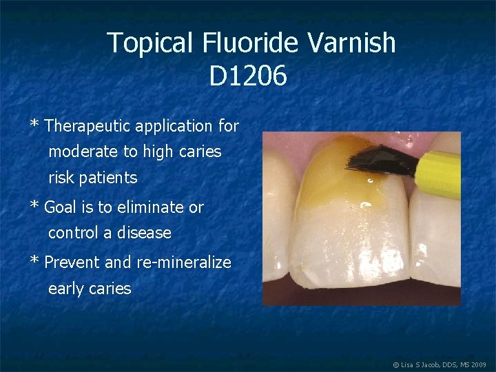 Topical Fluoride Varnish D 1206 * Therapeutic application for moderate to high caries risk