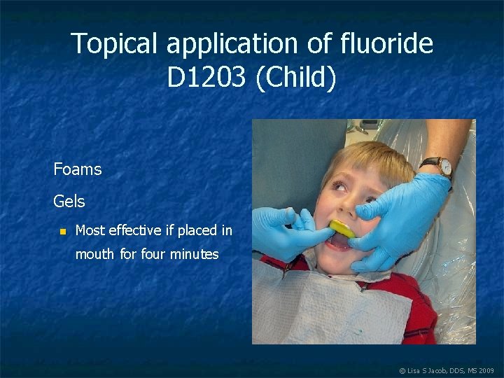 Topical application of fluoride D 1203 (Child) Foams Gels n Most effective if placed