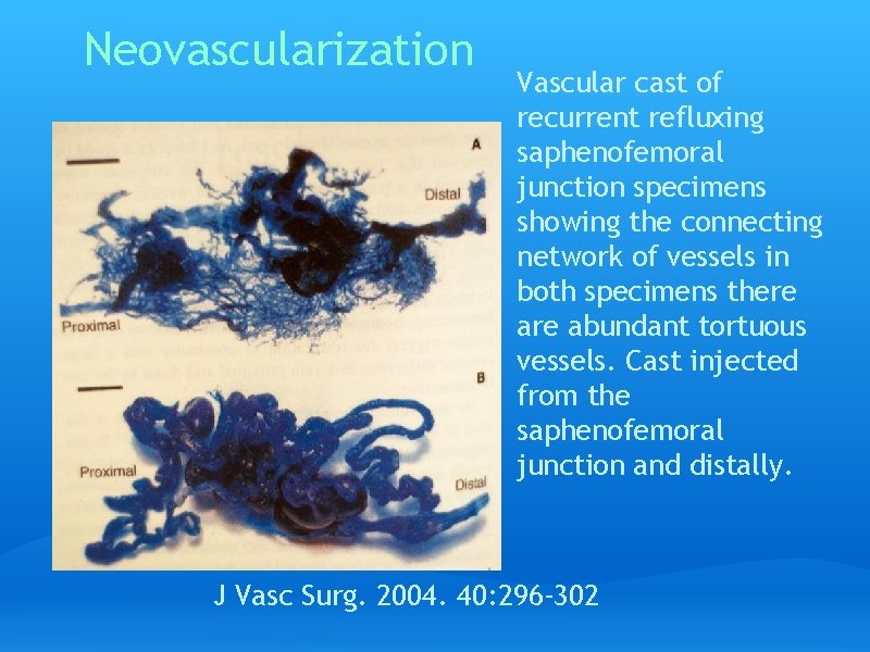Neovascularization Vascular cast of recurrent refluxing saphenofemoral junction specimens showing the connecting network of