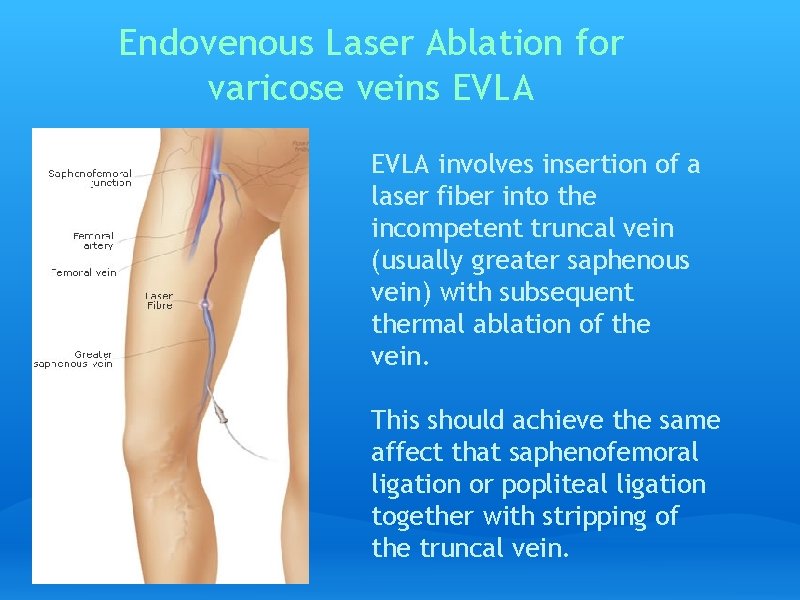 Endovenous Laser Ablation for varicose veins EVLA involves insertion of a laser fiber into