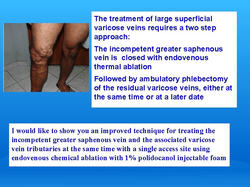 The treatment of large superficial varicose veins requires a two step approach: The incompetent