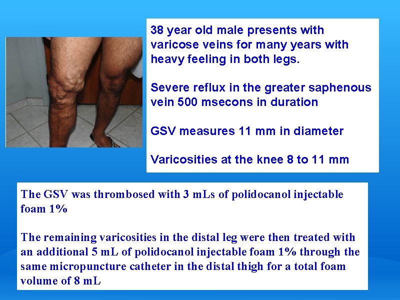 38 year old male presents with varicose veins for many years with heavy feeling