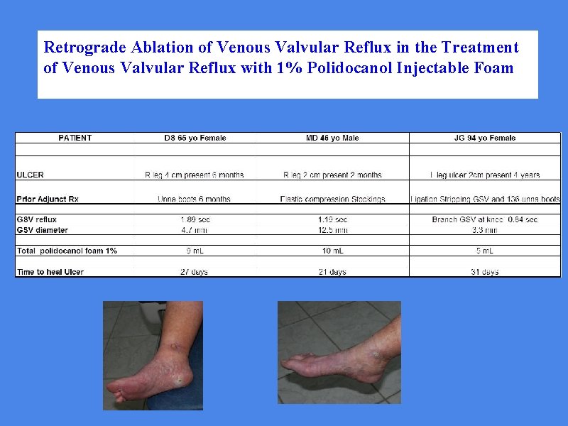 Retrograde Ablation of Venous Valvular Reflux in the Treatment of Venous Valvular Reflux with