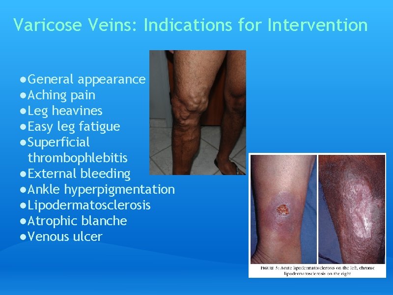 Varicose Veins: Indications for Intervention ● General appearance ● Aching pain ● Leg heavines
