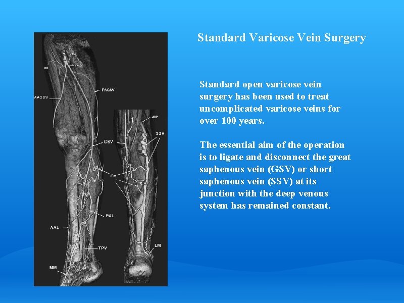 Standard Varicose Vein Surgery Standard open varicose vein surgery has been used to treat