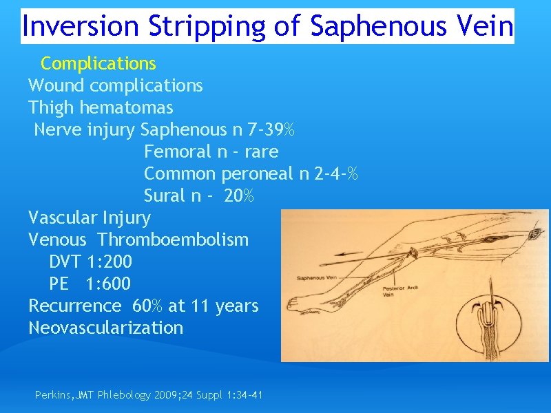 Inversion Stripping of Saphenous Vein Complications Wound complications Thigh hematomas Nerve injury Saphenous n