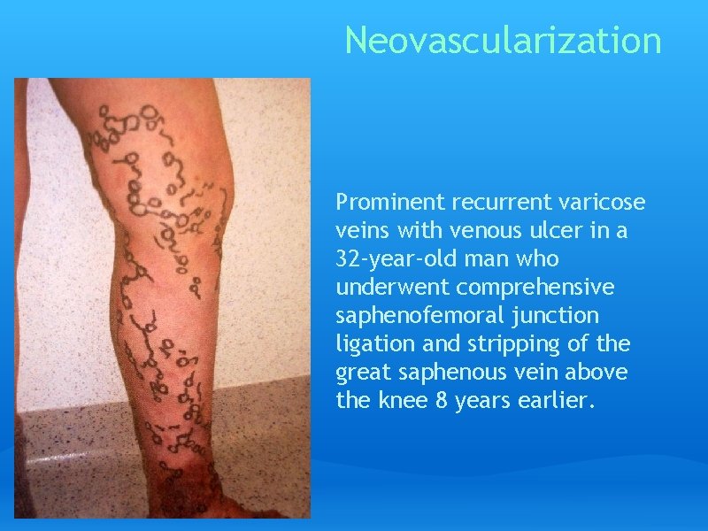 Neovascularization Prominent recurrent varicose veins with venous ulcer in a 32 -year-old man who
