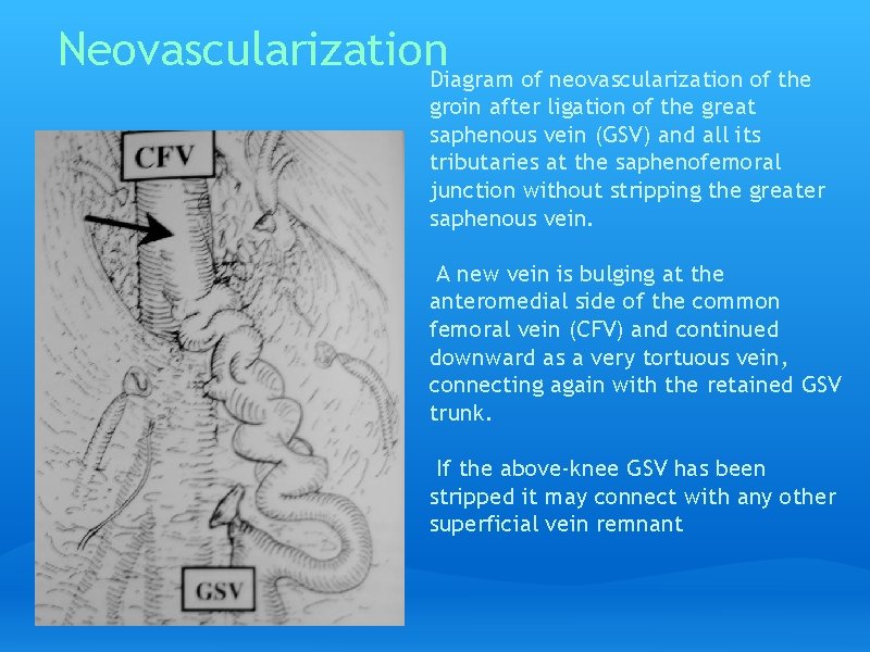 Neovascularization. Diagram of neovascularization of the groin after ligation of the great saphenous vein