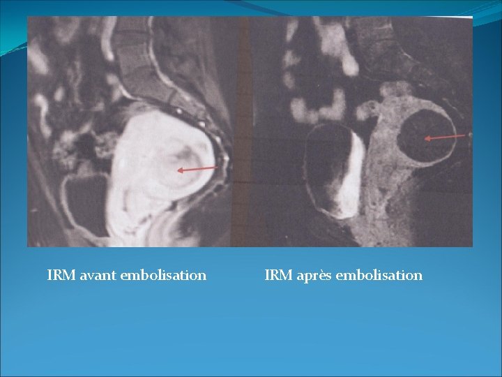 IRM avant embolisation IRM après embolisation 