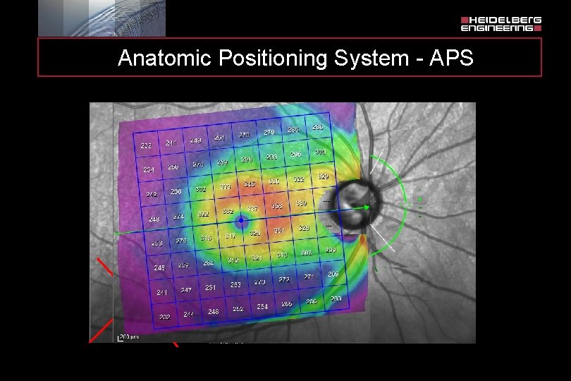 Anatomic Positioning System - APS BMO Fovea xis A Fo. BMO - 