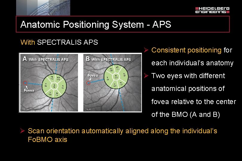 Anatomic Positioning System - APS With SPECTRALIS APS Ø Consistent positioning for each individual’s