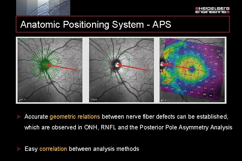 Anatomic Positioning System - APS Ø Accurate geometric relations between nerve fiber defects can