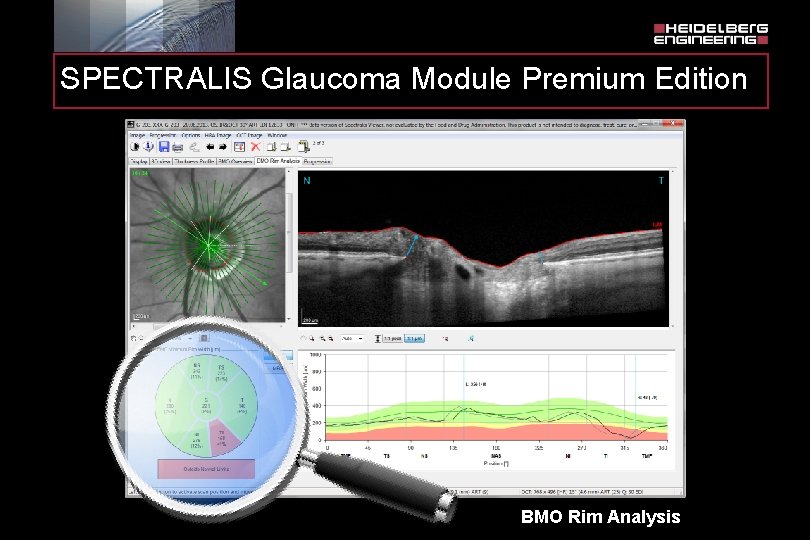 SPECTRALIS Glaucoma Module Premium Edition BMO Rim Analysis 